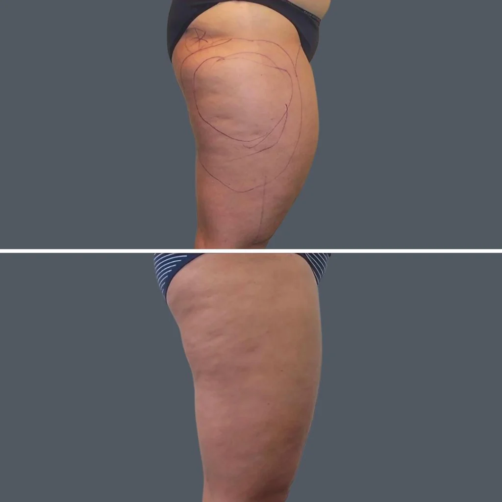 cellulite reduction female pre2024 011 before and after before and after