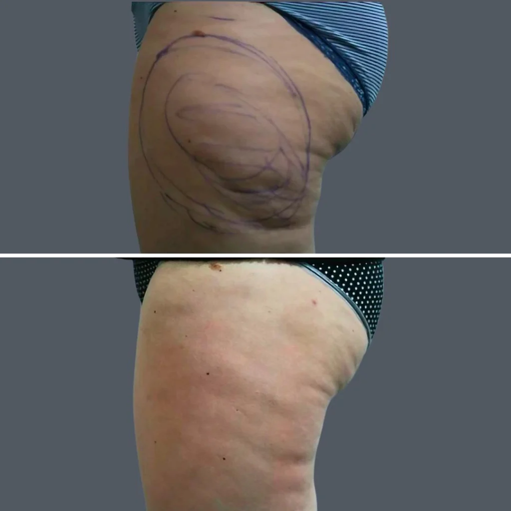cellulite reduction female pre2024 012 before and after before and after
