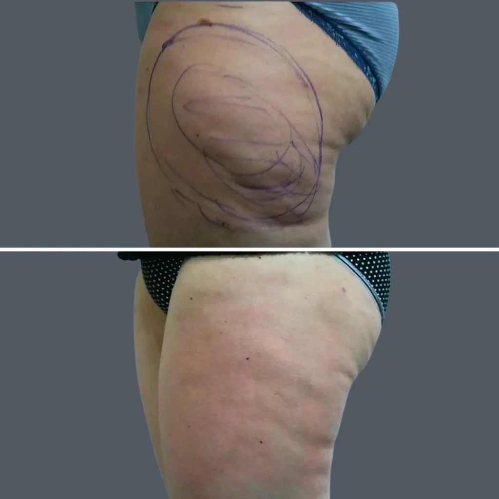 cellulite reduction female pre2024 013 before and after before and after