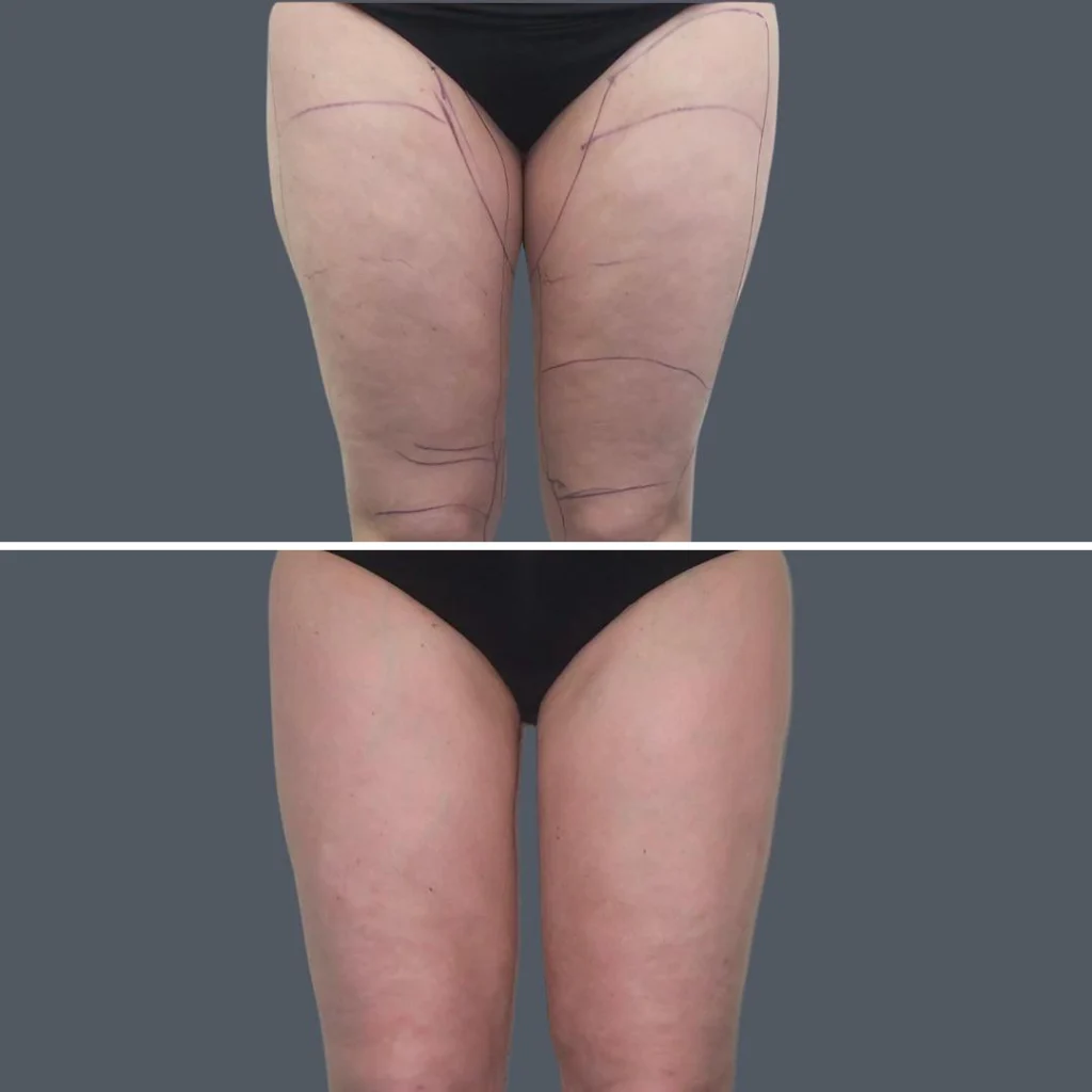 cellulite reduction female pre2024 014 before and after before and after