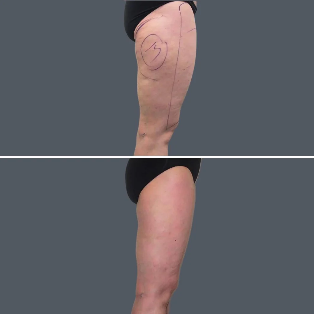 cellulite reduction female pre2024 015 before and after before and after