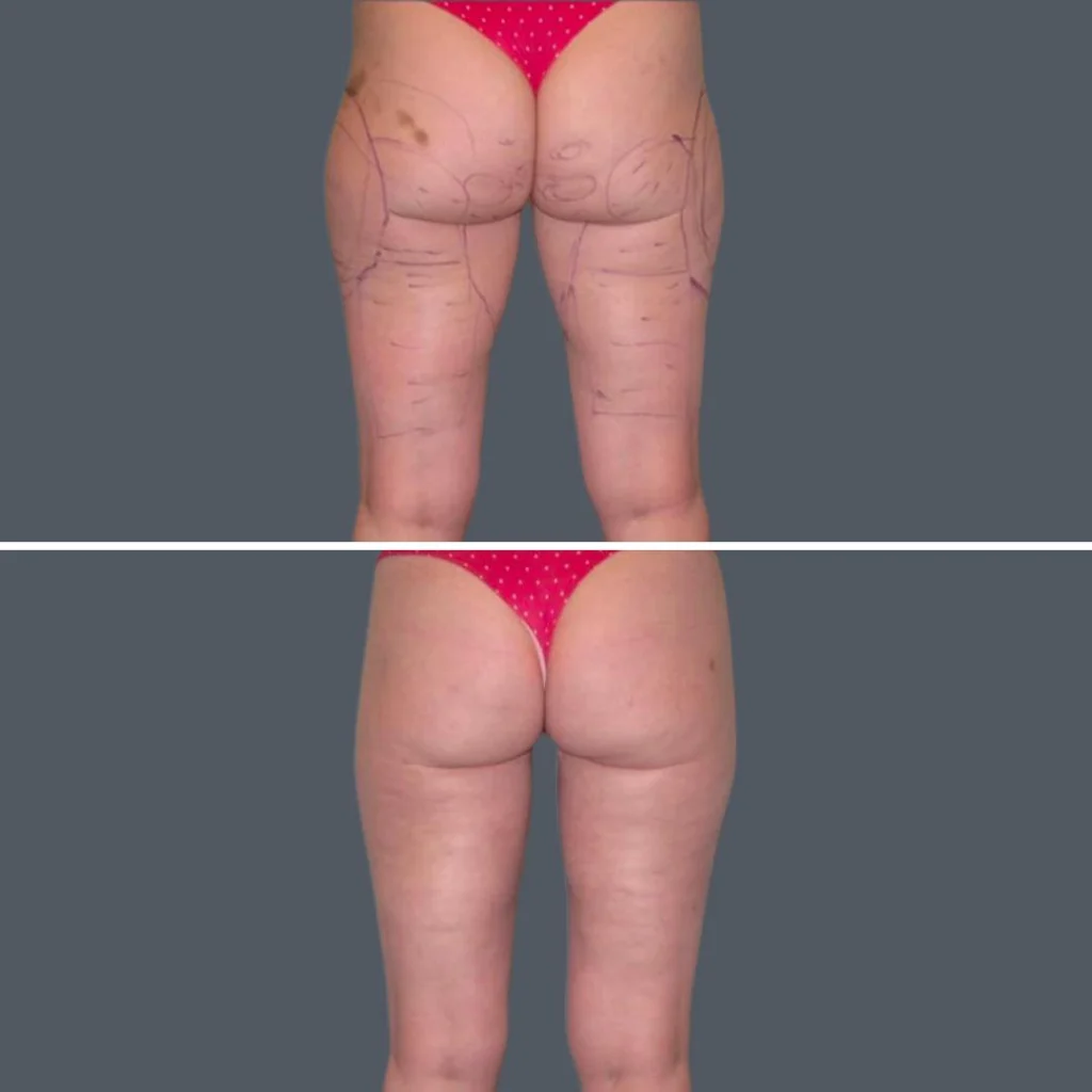cellulite reduction female pre2024 017 before and after before and after
