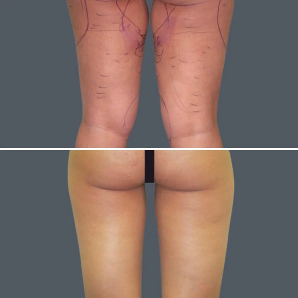 cellulite reduction female pre2024 019 before and after before and after