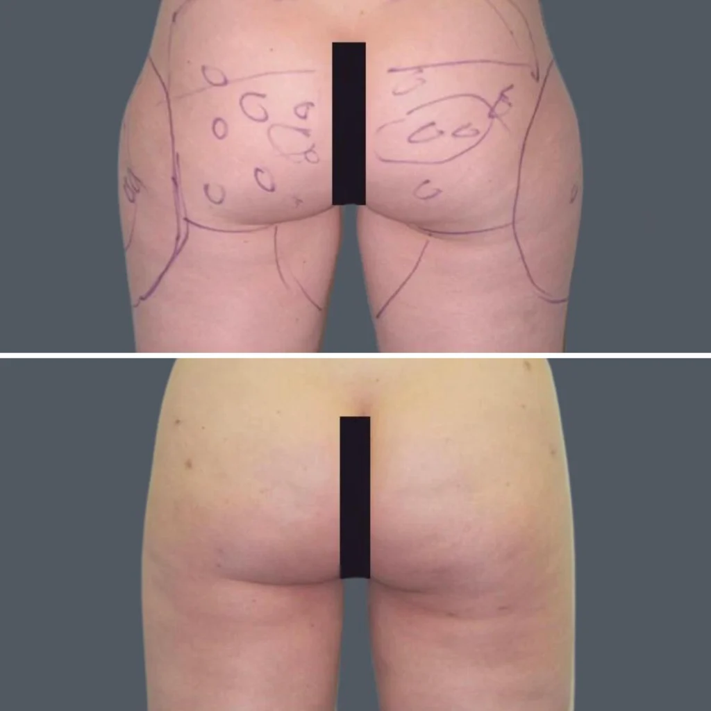 cellulite reduction female pre2024 020 before and after before and after