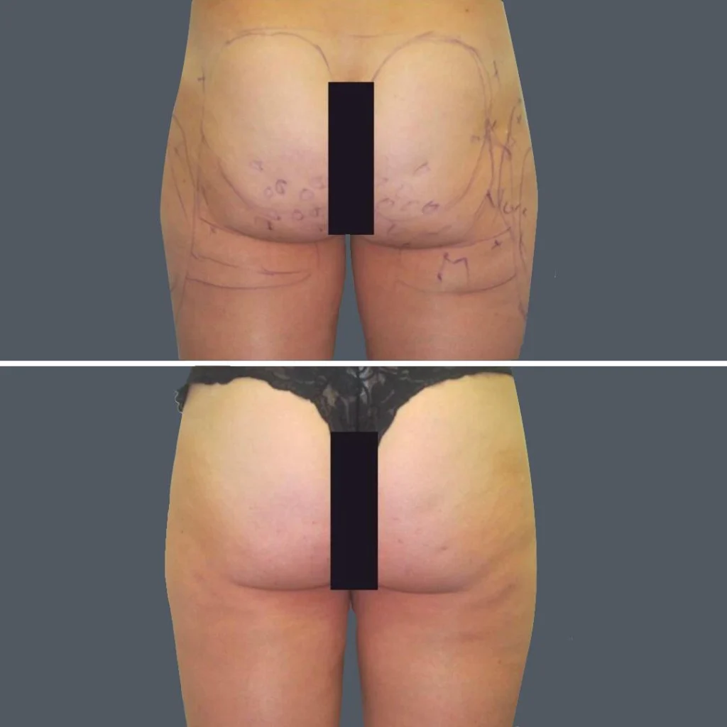 cellulite reduction female pre2024 021 before and after before and after