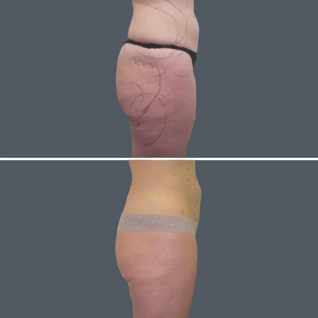 cellulite reduction female pre2024 022 before and after before and after