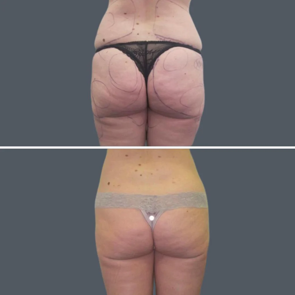 cellulite reduction female pre2024 023 before and after before and after