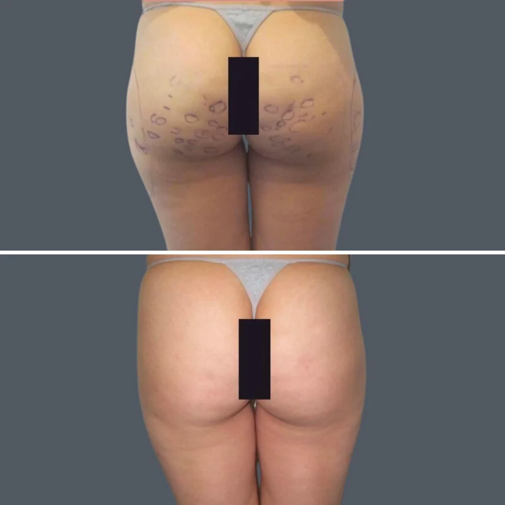 cellulite reduction female pre2024 024 before and after before and after