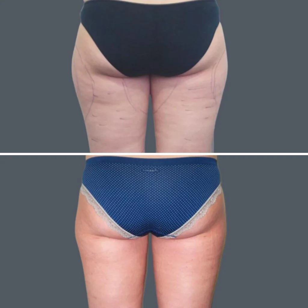cellulite reduction female pre2024 027 before and after before and after