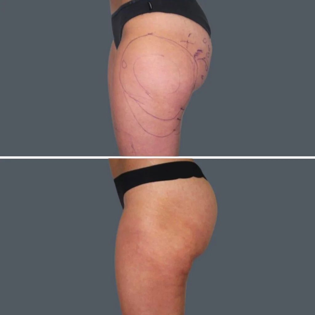 cellulite reduction female pre2024 029 before and after before and after