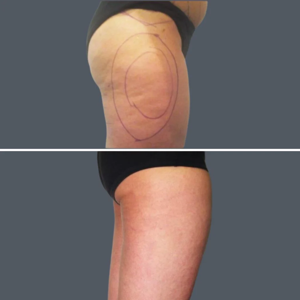 cellulite reduction female pre2024 030 before and after before and after