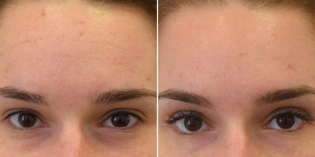 face anti wrinkle female pre2024 002 before and after before and after