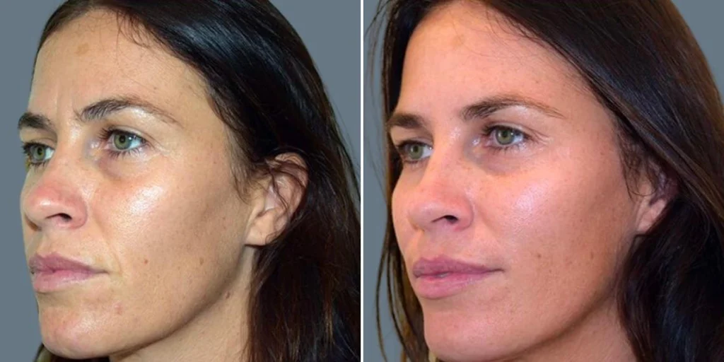 face anti wrinkle female pre2024 005 before and after before and after
