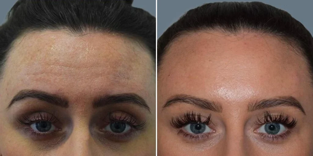 face anti wrinkle female pre2024 006 before and after before and after