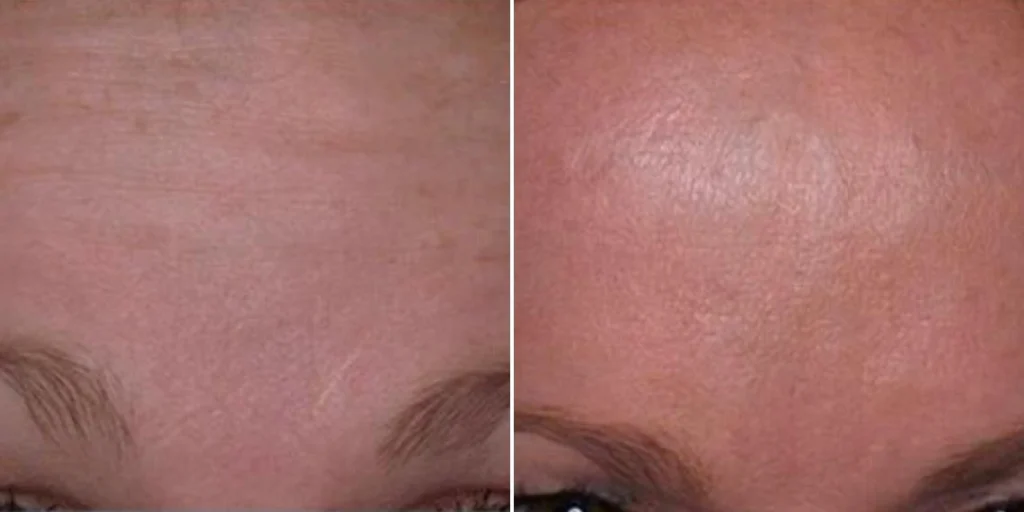 face anti wrinkle female pre2024 009 before and after before and after
