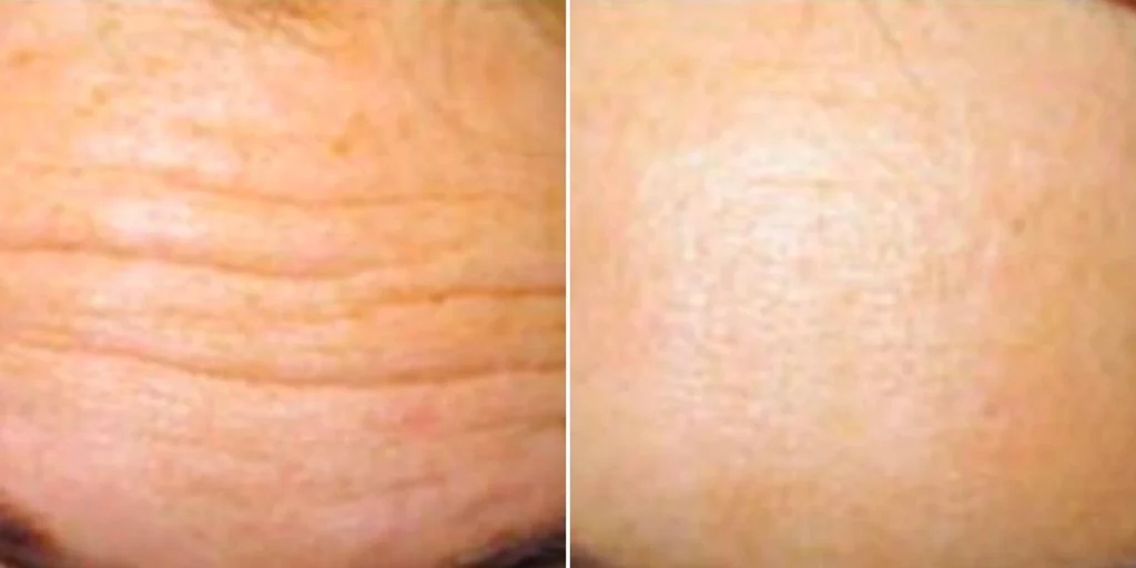 face anti wrinkle female pre2024 010 before and after before and after