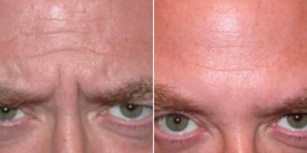 face anti wrinkle male pre2024 011 before and after before and after