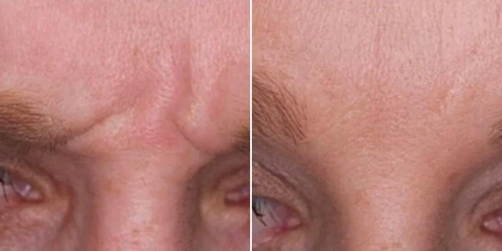 face anti wrinkle male pre2024 012 before and after before and after