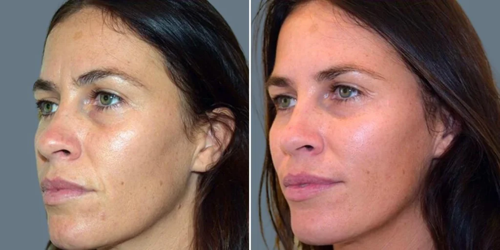 face cheek enhancement female pre2024 001 before and after before and after