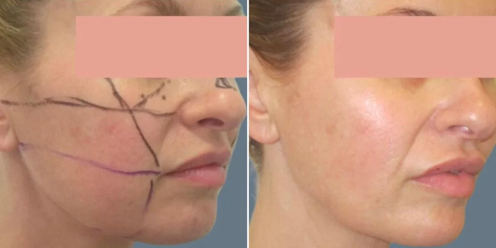 face cheek enhancement female pre2024 004 before and after before and after