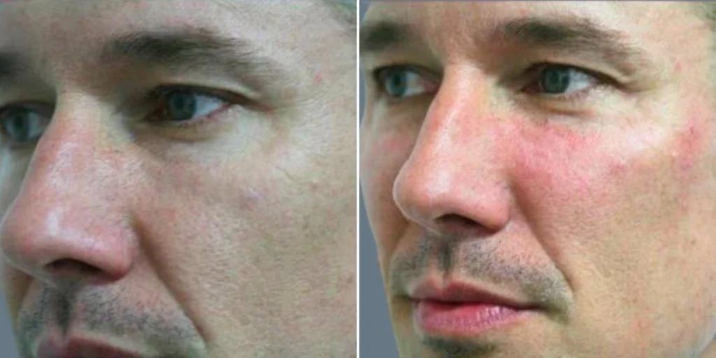 face cheek enhancement male pre2024 009 before and after before and after