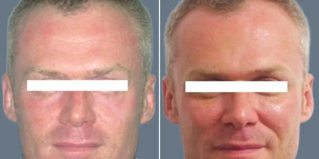 face cheek enhancement male pre2024 012 before and after before and after
