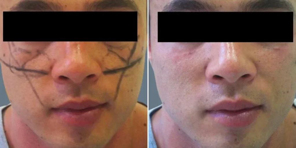 face cheek enhancement male pre2024 013 before and after before and after