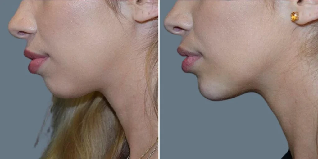 face chin enhancement female pre2024 003 before and after before and after