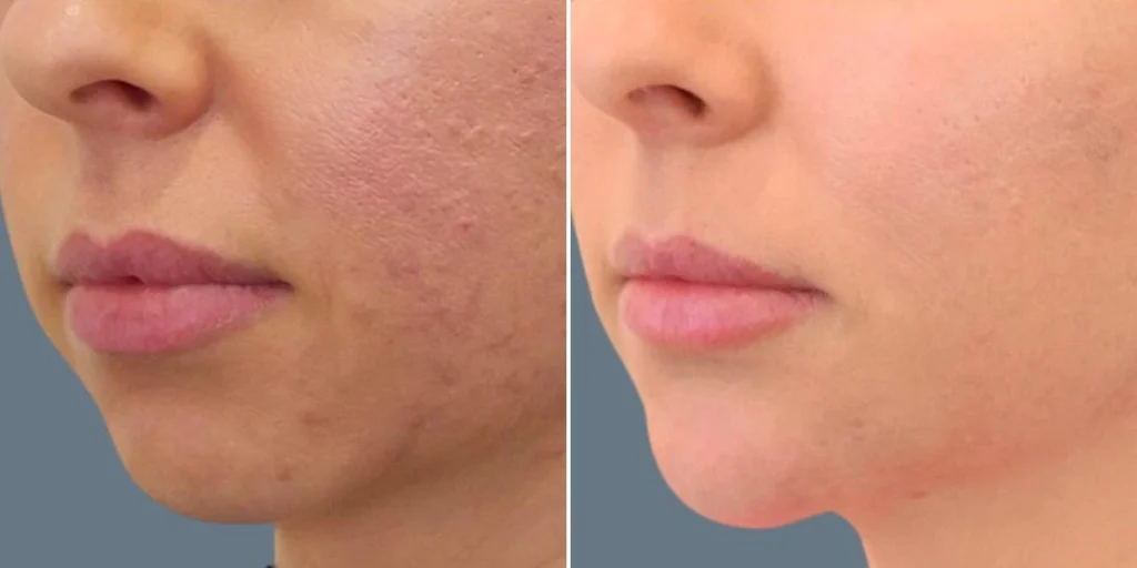 face chin enhancement female pre2024 005 before and after before and after