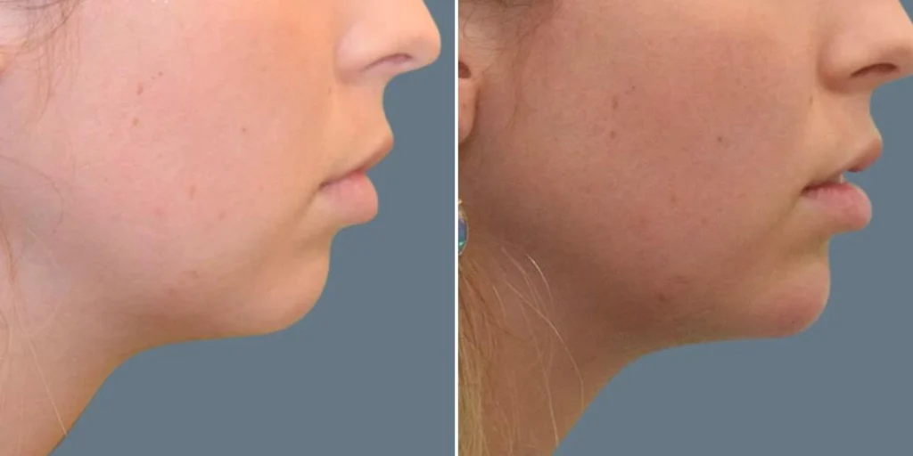 face chin enhancement female pre2024 007 before and after before and after