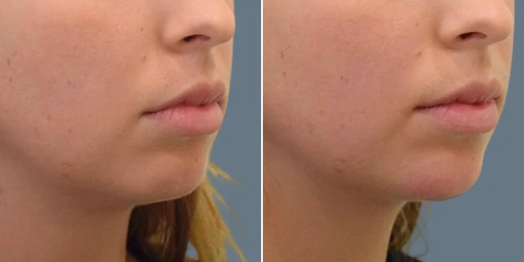face chin enhancement female pre2024 008 before and after before and after