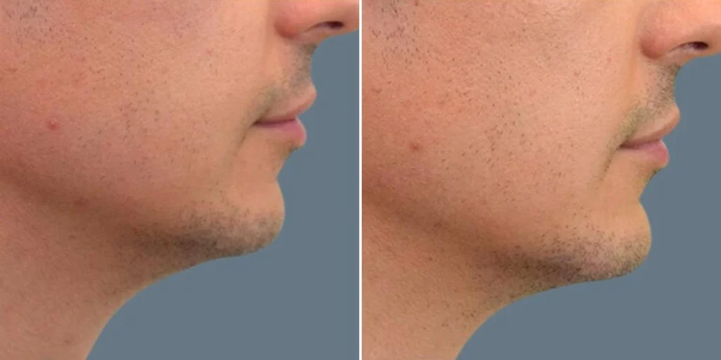 face chin enhancement male pre2024 004 before and after before and after