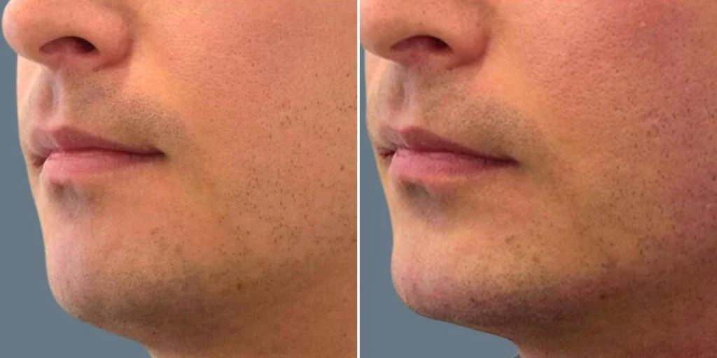 face chin enhancement male pre2024 009 before and after before and after