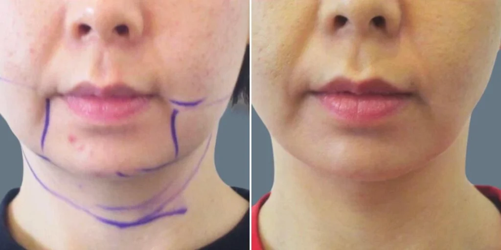 face chubby cheeks female pre2024 001 before and after before and after