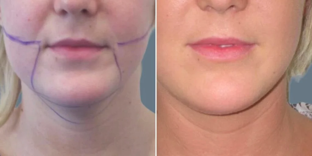 face chubby cheeks female pre2024 003 before and after before and after