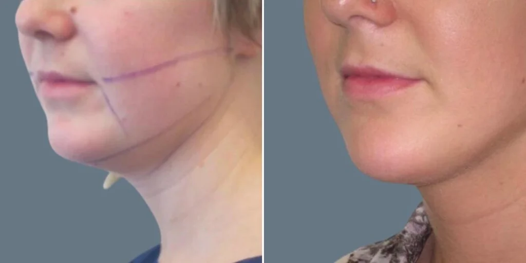 face chubby cheeks female pre2024 004 before and after before and after