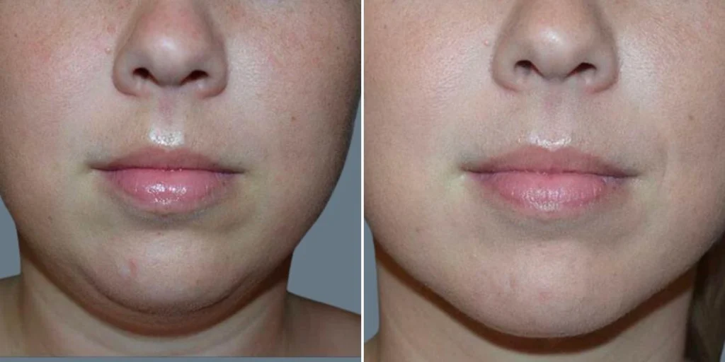 face chubby cheeks female pre2024 005 before and after before and after