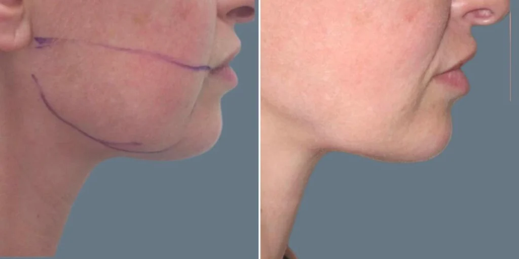 face chubby cheeks female pre2024 007 before and after before and after