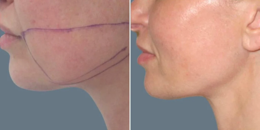 face chubby cheeks female pre2024 008 before and after before and after