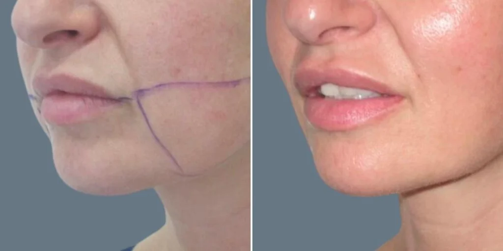 face chubby cheeks female pre2024 009 before and after before and after