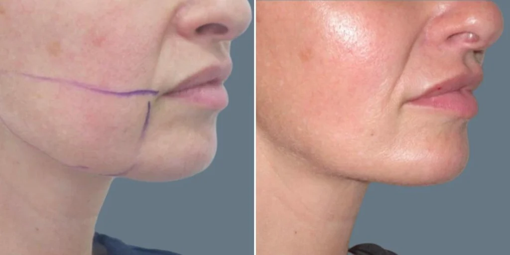 face chubby cheeks female pre2024 010 before and after before and after