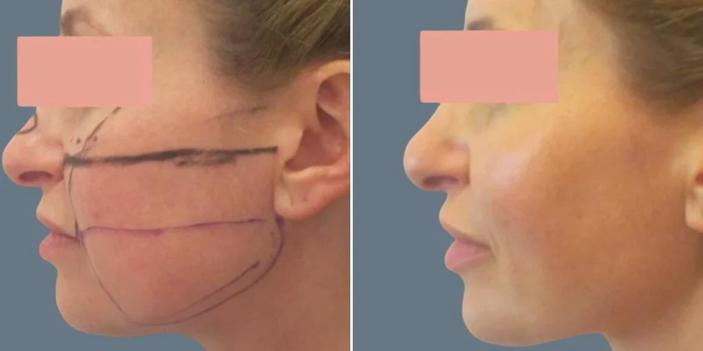 face chubby cheeks female pre2024 012 before and after before and after