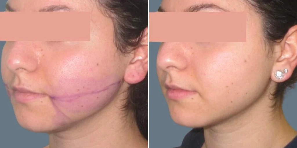 face chubby cheeks female pre2024 017 before and after before and after