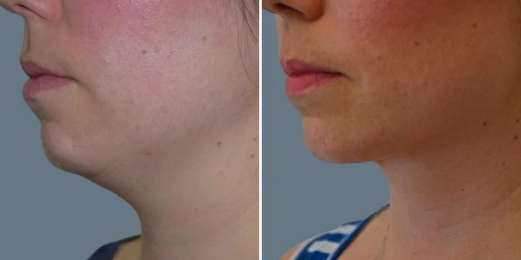 face chubby cheeks female pre2024 020 before and after before and after