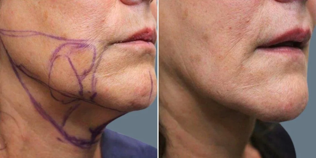 face chubby cheeks female pre2024 021 before and after before and after