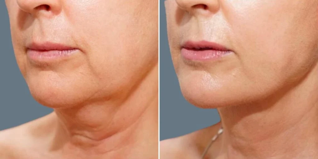 face chubby cheeks female pre2024 022 before and after before and after