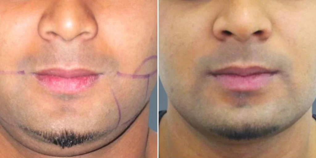 face chubby cheeks male pre2024 014 before and after before and after