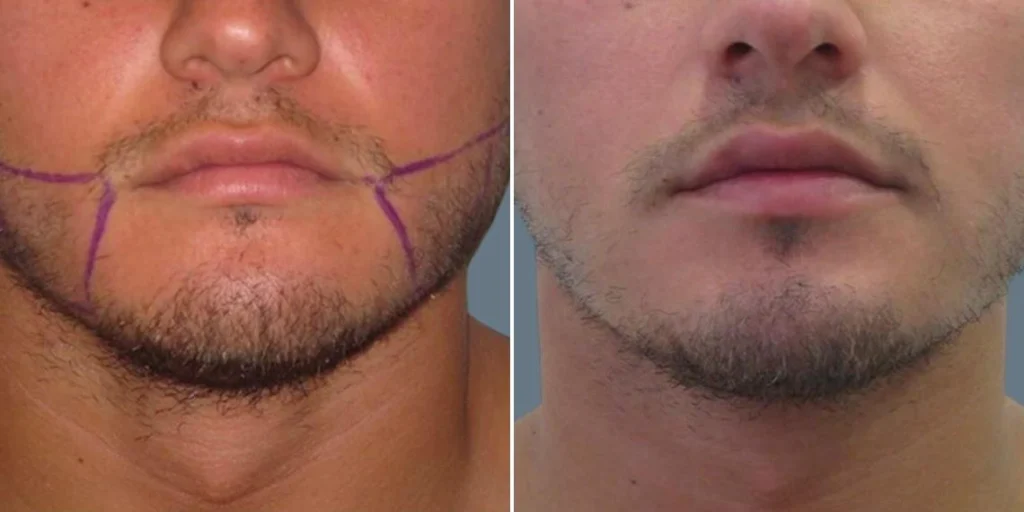face chubby cheeks male pre2024 018 before and after before and after