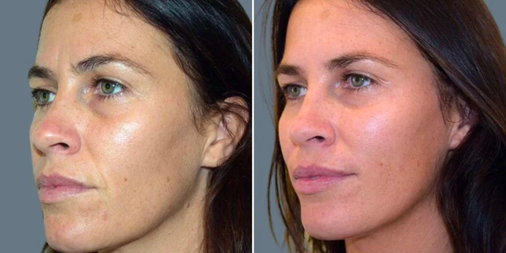 face Volume Enhancement Treatments female pre2024 001  before and after before and after