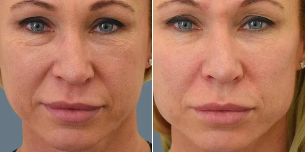 face Volume Enhancement Treatments female pre2024 005 before and after before and after